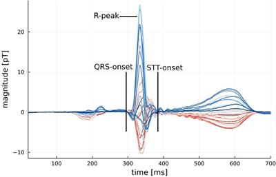 Cardiac magnetic field map topology quantified by Kullback–Leibler entropy identifies patients with clinically suspected myocarditis